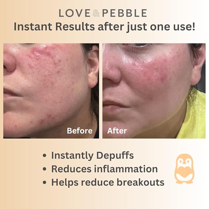 Love & Pebble Beauty Pops - Ice Roller Massage & Skin Care Ice Mask for Face Set with Turmeric & Aloe | Cryo Dermal Benefits of Ice Face Roller and Gua Sha, As Seen on Shark Tank and Tik Tok