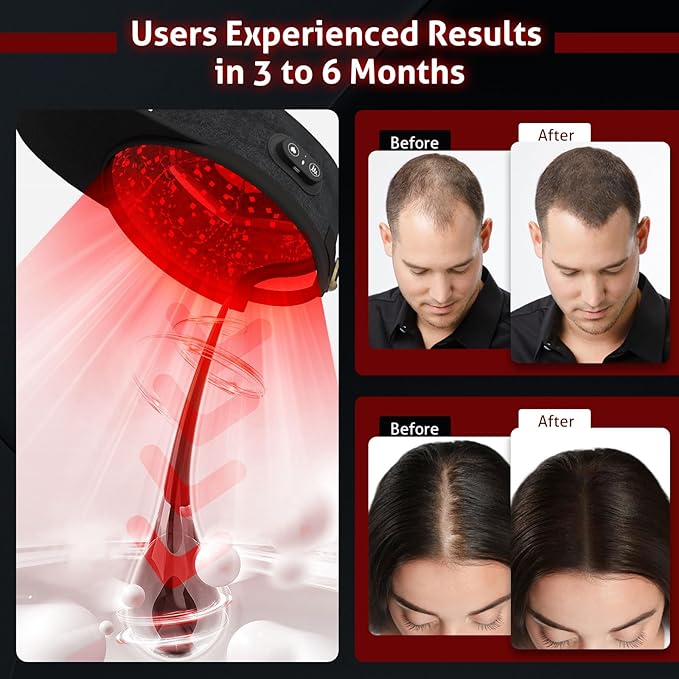 Laser Cap for Hair Growth, Wireless Red Light Therapy for Hair Growth, Strengthen Hair Roots, Hair Loss Treatment for Men and Women