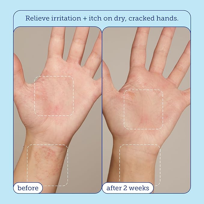 Skinfix Eczema+ Hand Relief Cream: Hydrating Hand Repair Cream to Address Eczema & Dry, Cracked, Sensitive Skin, 3 Fl Oz