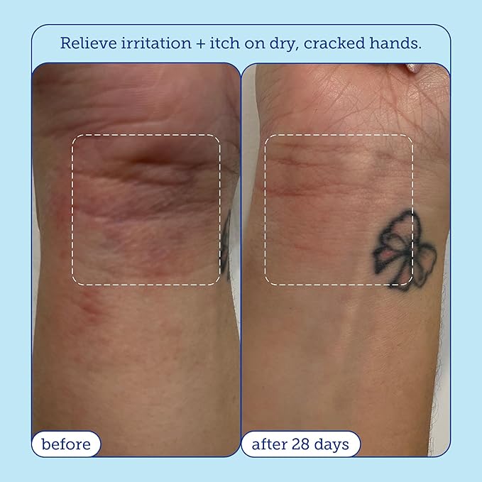 Skinfix Eczema+ Hand Relief Cream: Hydrating Hand Repair Cream to Address Eczema & Dry, Cracked, Sensitive Skin, 3 Fl Oz