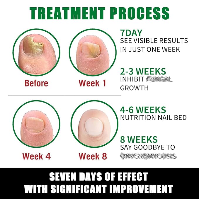 Ginger Nail Treatment Nail Support