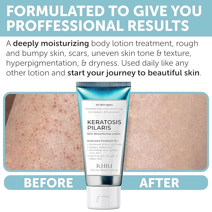 Keratosis Pilaris Treatment | Keratosis Pilaris Lotion | KP Lotion | Gentle Exfoliation For Strawberry Legs, KP & Ingrown Hairs | Smooth & Hydrating Body Lotion For Redness, Dry, Rough And Flaky Skin