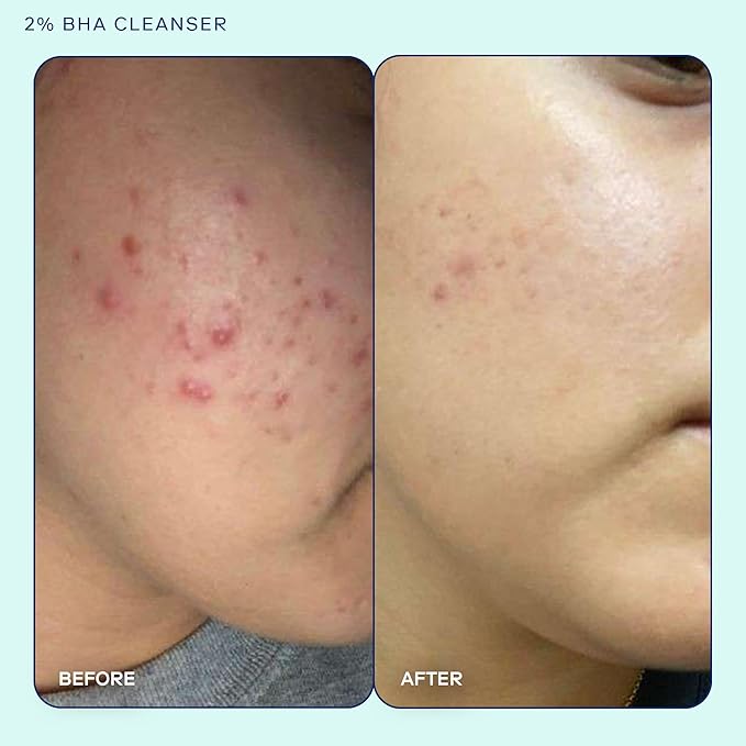 Skinfix Acne+ BHA Cleanser: Multi-Level Pore Resurfacing, Deep Pore & Acne-Fighting Cleanser Helps Reduce Blemish Size, Redness & Excess Oil, 5 Fl Oz