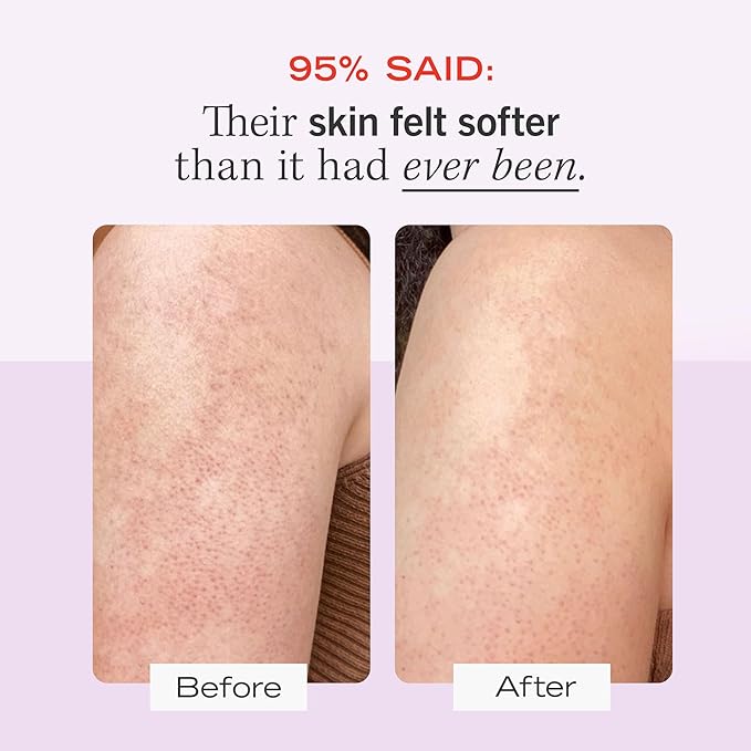 First Aid Beauty - KP Bump Eraser Body Scrub with 10% AHA, Keratosis Pilaris Skin Exfoliator with Glycolic and Lactic acids, Helps Reduce Chicken Skin Bumps, Safe for Sensitive Skin, 8 oz