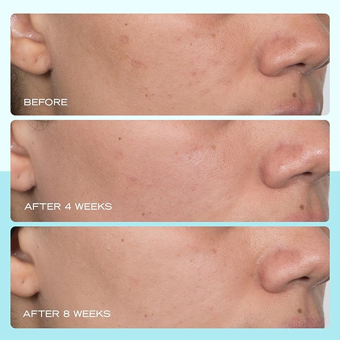 First Aid Beauty - Dark Spot Serum with Niacinamide, Helps Reduce Look of Dark Spots, Sun Spots, Hyperpigmentation, Discoloration & Post-acne marks, Non-Comedogenic, Safe for Sensitive Skin, 1 oz