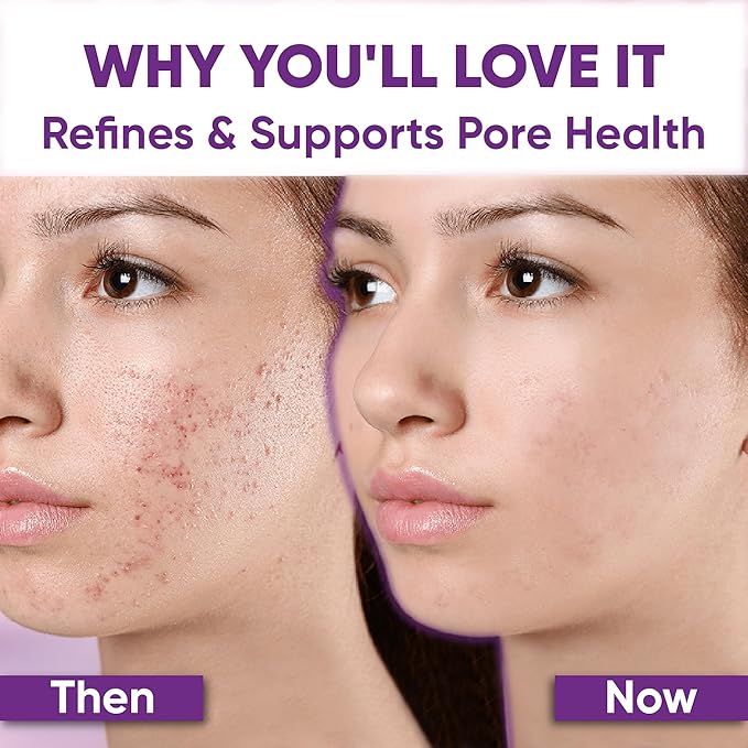 Azelaic Acid Acne Cream: Azelaic Acid For Face - Premium Azelaic Acid Cream - Face Skin and Beauty Care - Azelaic Acid Facial Cream, 1 Oz