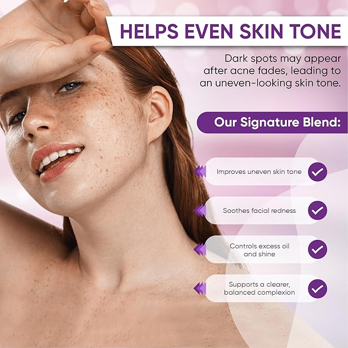Azelaic Acid Acne Cream: Azelaic Acid For Face - Premium Azelaic Acid Cream - Face Skin and Beauty Care - Azelaic Acid Facial Cream, 1 Oz