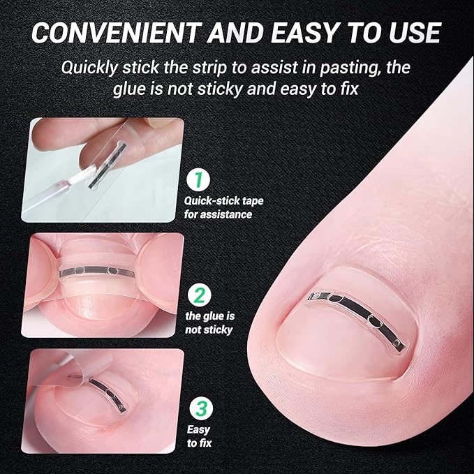 Titanium alloy ingrown toenail treatment-