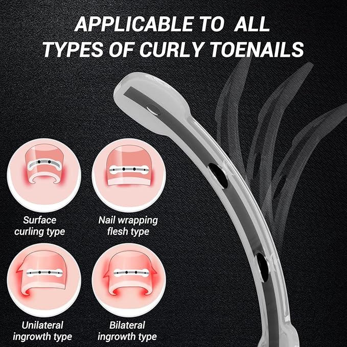 Titanium alloy ingrown toenail treatment-