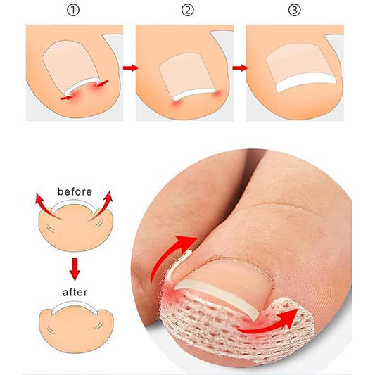 Ingrown Toenail Treatment: 120Pcs Breathable