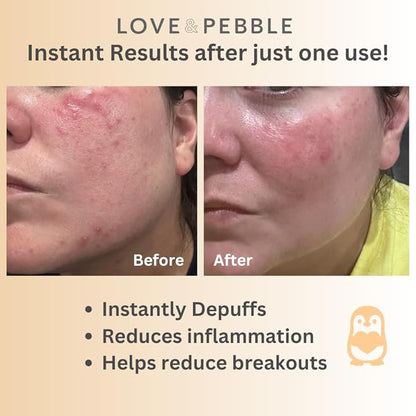 Love & Pebble Beauty Pops - Ice Roller Massage & Skin Care Ice Mask for Face Set with Turmeric & Aloe | Cryo Dermal Benefits of Ice Face Roller and Gua Sha, As Seen on Shark Tank and Tik Tok