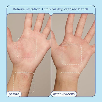 Skinfix Eczema+ Hand Relief Cream: Hydrating Hand Repair Cream to Address Eczema & Dry, Cracked, Sensitive Skin, 3 Fl Oz