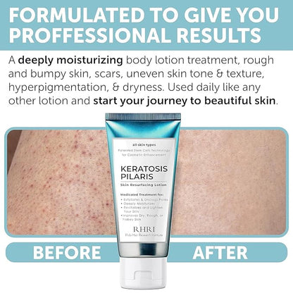 Keratosis Pilaris Treatment | Keratosis Pilaris Lotion | KP Lotion | Gentle Exfoliation For Strawberry Legs, KP & Ingrown Hairs | Smooth & Hydrating Body Lotion For Redness, Dry, Rough And Flaky Skin