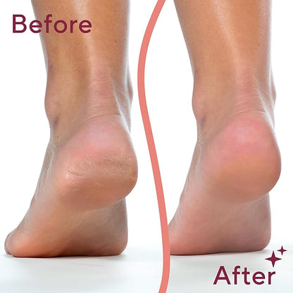 Finishing Touch Flawless Pedi Electronic Tool File and Callus Remover, Pedicure-New Version (Amazon Exclusive)