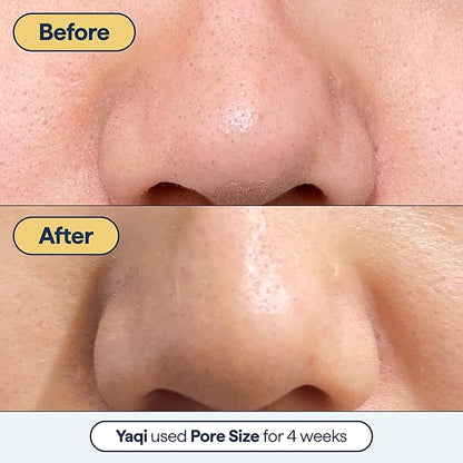 Remedy for Pore Size – Large Pore Minimizer with Retinol, BHA Salicylic Acid, Niacinamide – for Uneven Texture, Pimples, Blackheads, Whiteheads, Sebaceous Filaments – by Dermatologist Dr. Shah