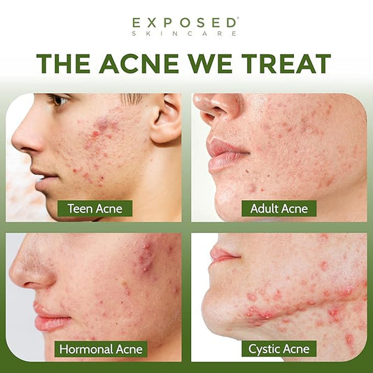 Exposed Skin Care Acne Treatment Kit - Includes Facial Cleanser, Clearing Tonic, Acne Treatment Serum, Clear Pore Serum, Clarifying Mask, Cloth - Natural Acne Solution for Face, All Ages & Skin Types