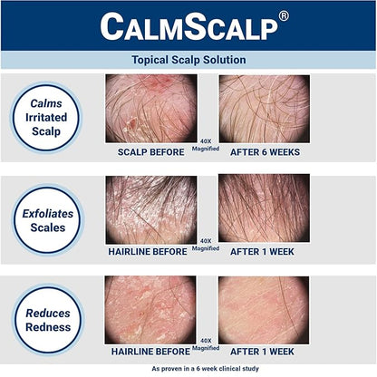 Scalp Solution | Calms Irritated Scalp | Dry Scalp Treatment | Reduces Scales, Flakes & Redness | Clinically Proven | Free of Steroids | Non Shampoo Leave-On Scalp Treatment | 4 oz