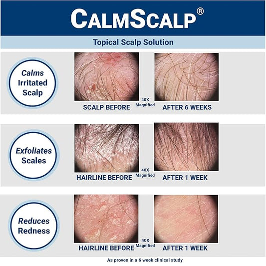 Scalp Solution | Calms Irritated Scalp | Dry Scalp Treatment | Reduces Scales, Flakes & Redness | Clinically Proven | Free of Steroids | Non Shampoo Leave-On Scalp Treatment | 4 oz