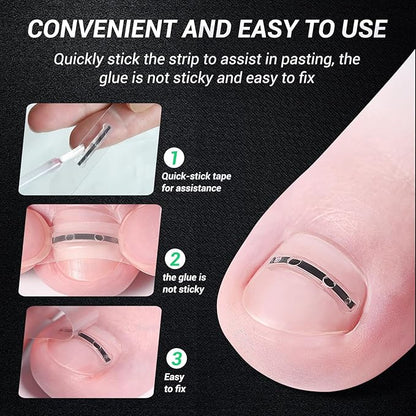 Titanium alloy ingrown toenail treatment-