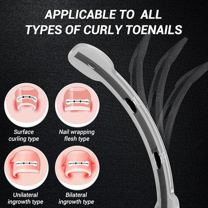 Titanium alloy ingrown toenail treatment